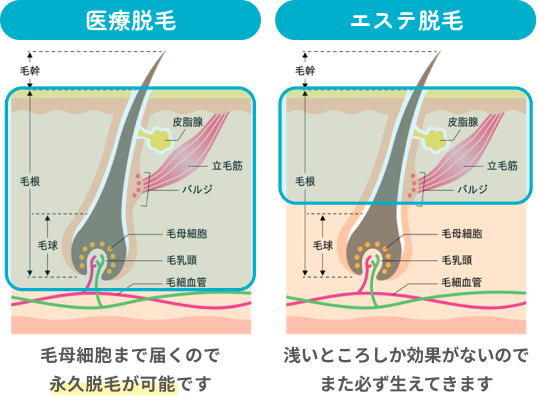 永久脱毛とエステ脱毛の比較。永久脱毛は毛母細胞まで届くので永久脱毛が可能です。一方、エステ脱毛は浅いところしか効果がないのでまた必ず生えてきます