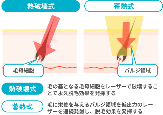 熱破壊式は毛の基となる毛母細胞をレーザーで破壊することで永久脱毛効果を発揮する。蓄熱式は毛に栄養を与えるバルジ領域を低出力のレーザーを連続発射し、脱毛効果を発揮する