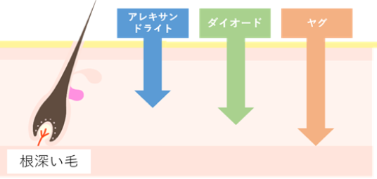 波長のイメージ：アレキサンドライト、ダイオード、ヤグ