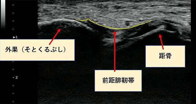 足首のエコー画像