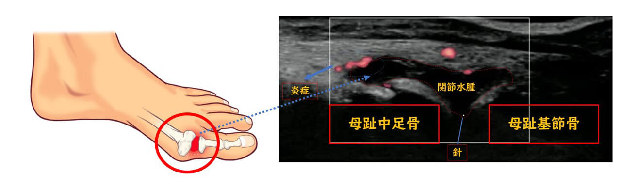 【画像】母趾MTP関節（中足骨と基節骨間）にステロイド入りの注射