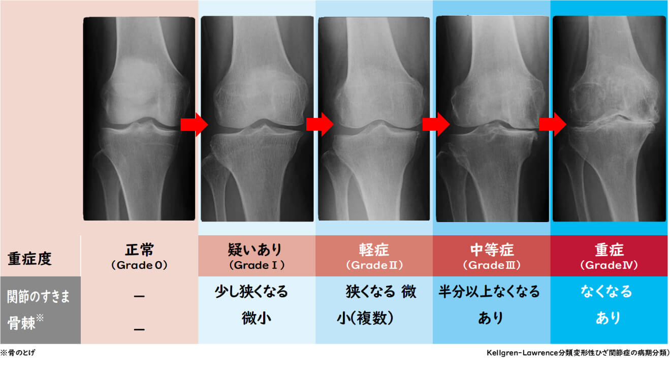 【画像】変形性ひざ関節症の進行