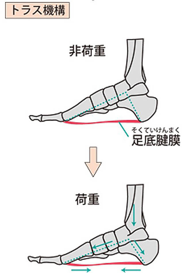 【画像】足底腱膜炎