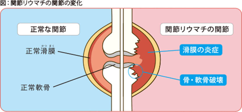 図：関節リウマチの関節の変化