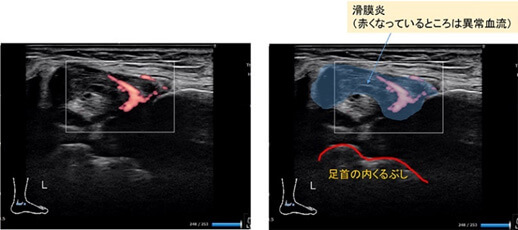 図：炎症が起こっているところに血流が集まり、炎症が起こっていることが分かります