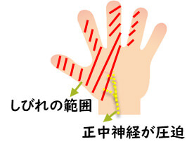 【画像】手根管症候群の症状