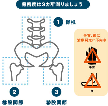 骨密度は3カ所測りましょう