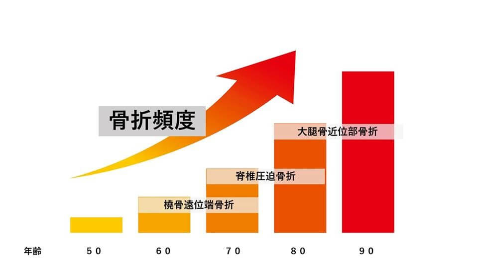 骨粗鬆症①　骨粗鬆症による骨折について