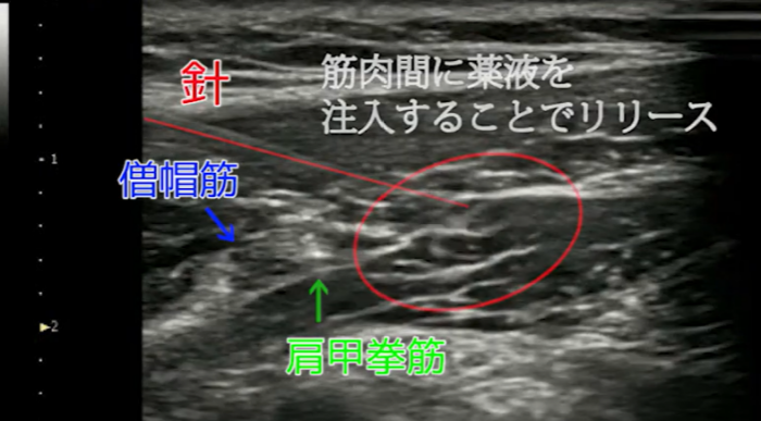 当院の肩こり治療